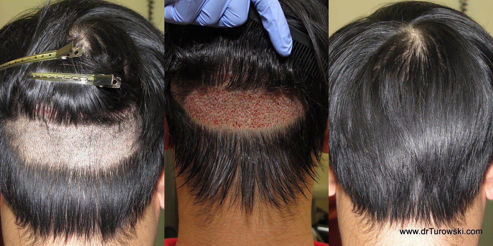 Un-Shaven Hair Transplant Technique